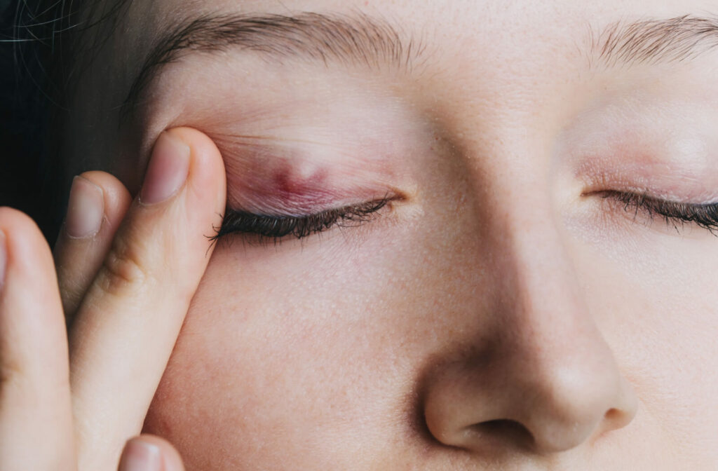 young girl shows a chalazion on the eyelid closeup