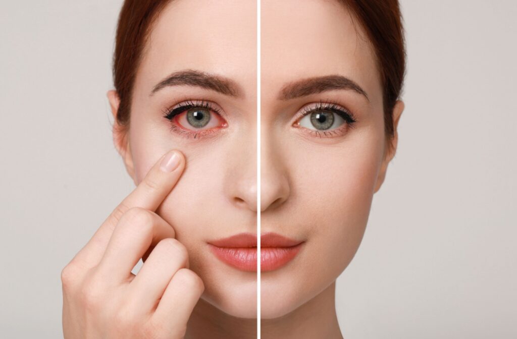 A side-by-side comparison of a pink eye on the left and a normal eye on the right