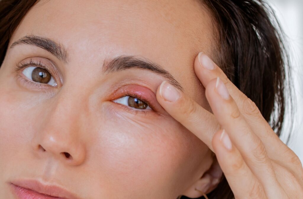 A person with a stye, touching their eyelid.